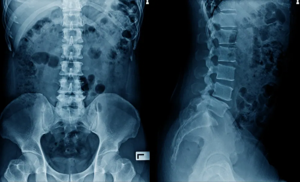 Spine X-ray
